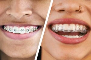 dental invisalign near me