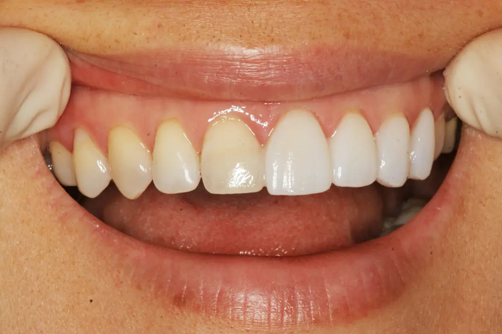 Teeth whitening in Agoura Hills